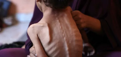 Un bambino magro viene tenuto in braccio, evidenziando la sua vulnerabilità e sofferenza.