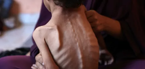 Un enfant très maigre est soutenu par une personne, exprimant une grande détresse.
