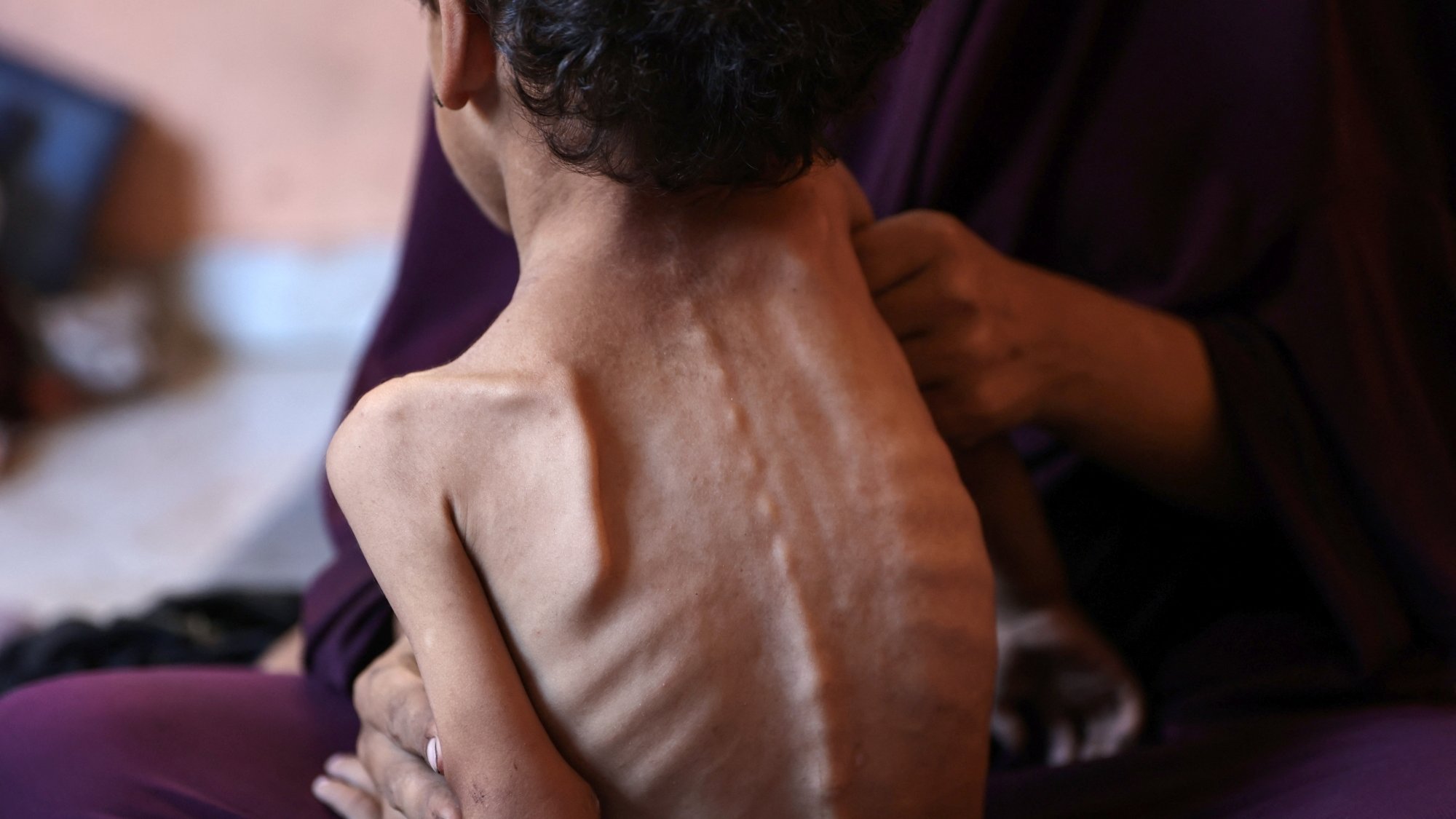 تصویر یک کودک لاغر و آسیبپذیر را نشان میدهد که در آغوش یک زن نشسته است.