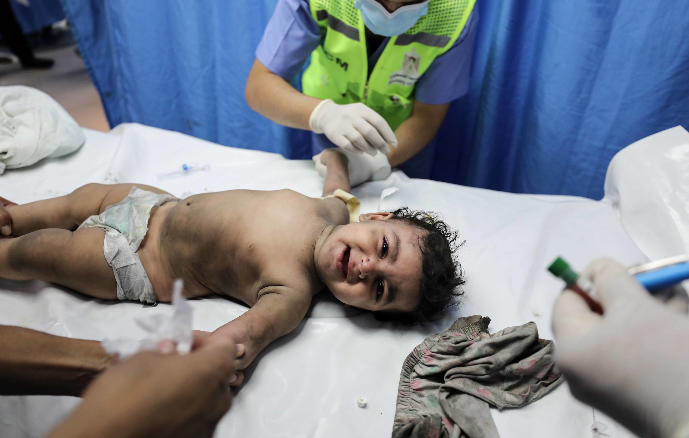 L'image montre un bébé allongé sur une table d'examen médical. L'enfant semble être en cours de traitement, entouré de personnel médical qui lui porte attention. Il est vêtu d'une couche et a un air triste, tout en étant manipulé avec précaution. Le décor est celui d'un hôpital, avec des rideaux bleus en arrière-plan. Des instruments médicaux peuvent être visibles autour de lui.