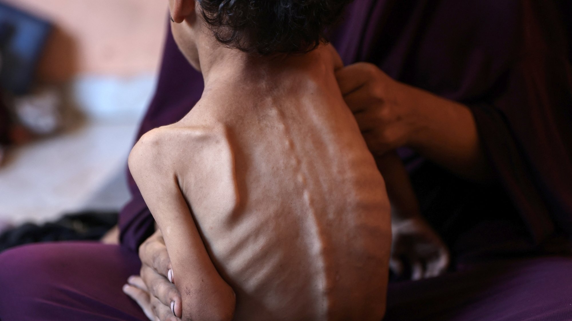 Un enfant très maigre est soutenu par une personne, exprimant une grande détresse.