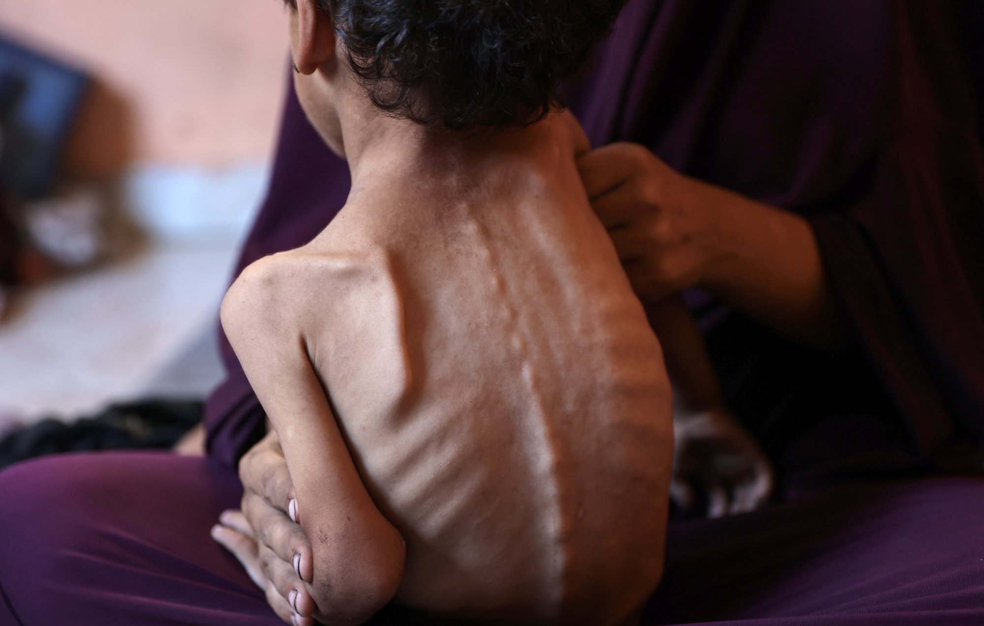 Un enfant très maigre est soutenu par une personne, exprimant une grande détresse.