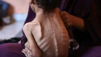 Un enfant très maigre est soutenu par une personne, exprimant une grande détresse.