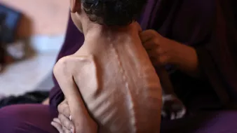 Un bambino magro viene tenuto in braccio, evidenziando la sua vulnerabilità e sofferenza.