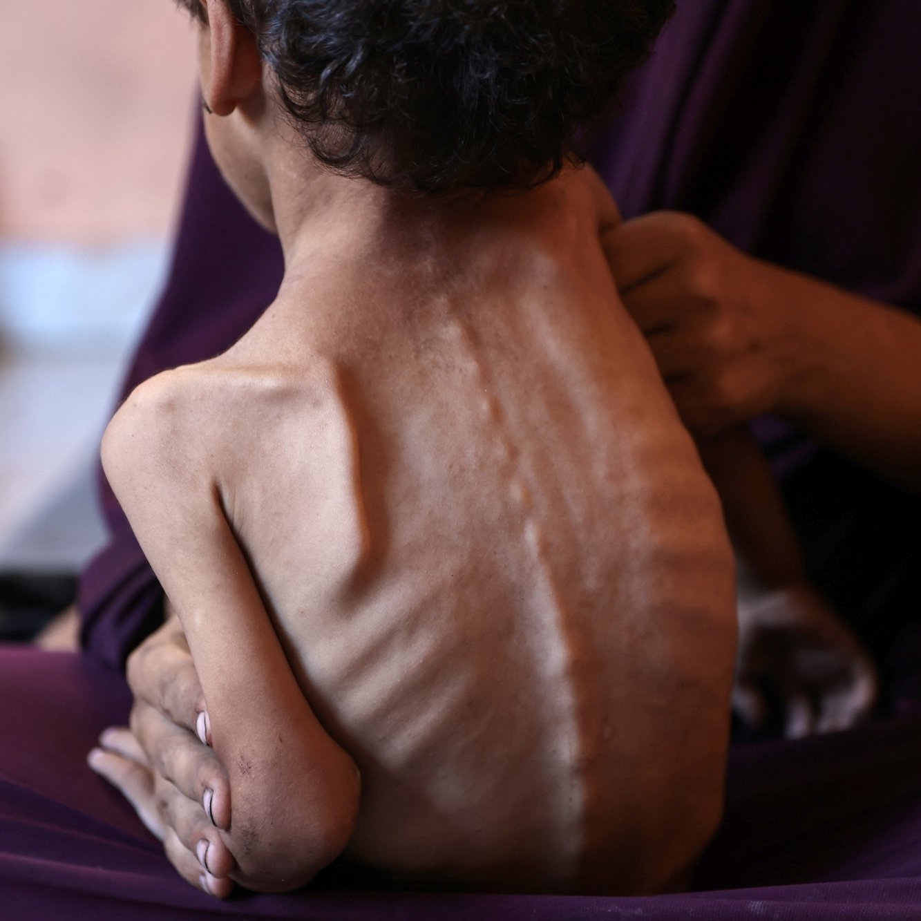 Un bambino magro viene tenuto in braccio, evidenziando la sua vulnerabilità e sofferenza.