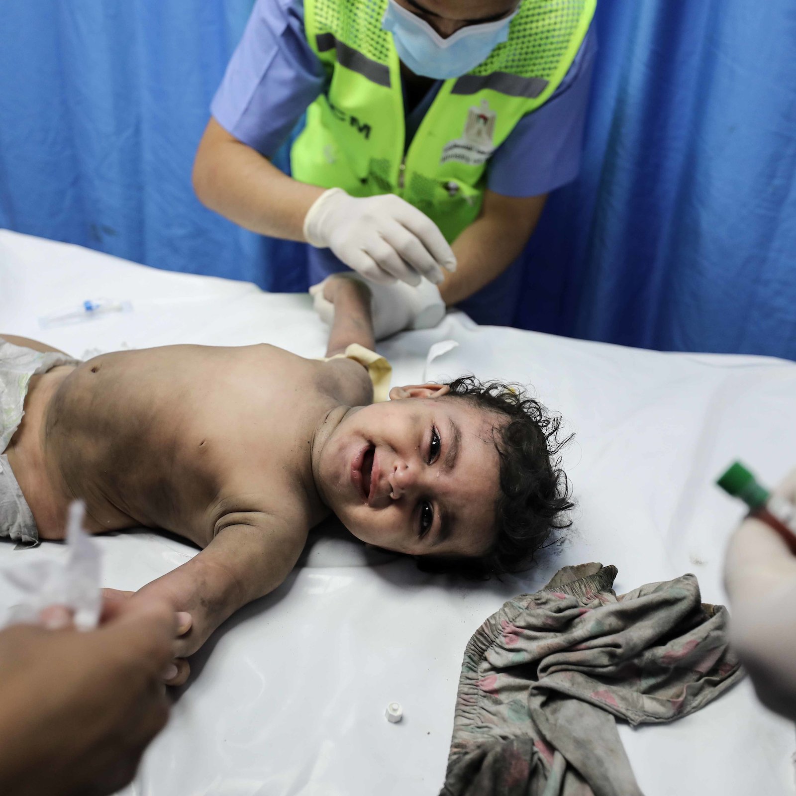 در این تصویر، یک کودک خردسال در حال معاینه پزشکی قرار دارد. کودک به شکم دراز کشیده و لبخند می‌زند، در حالی که دست‌های پزشک یا پرستار در حال ارائه درمان یا رسیدگی به او است. محیط بیمارستانی به وضوح دیده می‌شود و پس‌زمینه شامل پرده‌هایی است که حریم خصوصی را حفظ می‌کنند. وضعیت کودک به نظر نیاز به مراقبت پزشکی دارد.