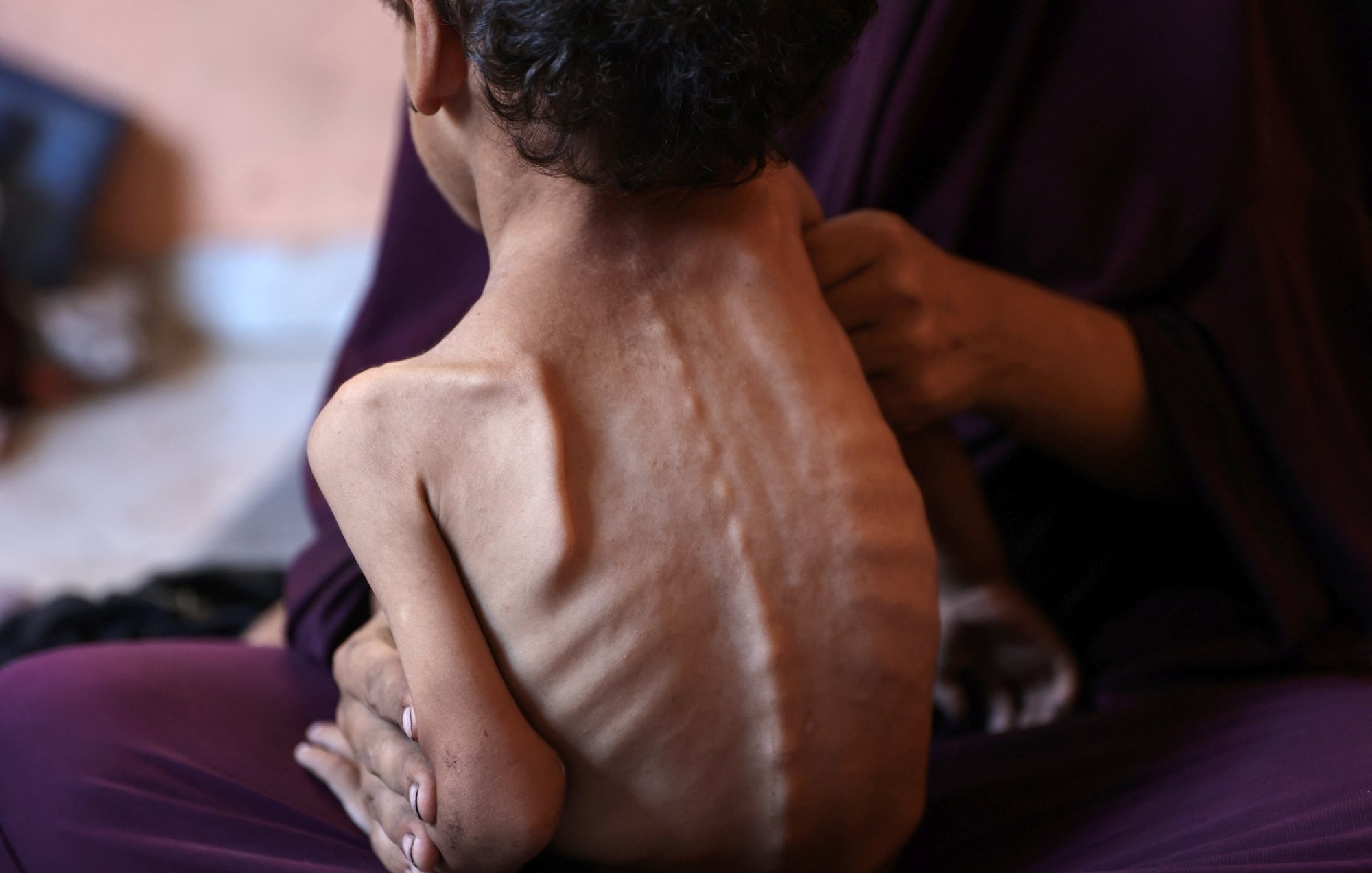 Un bambino magro viene tenuto in braccio, evidenziando la sua vulnerabilità e sofferenza.