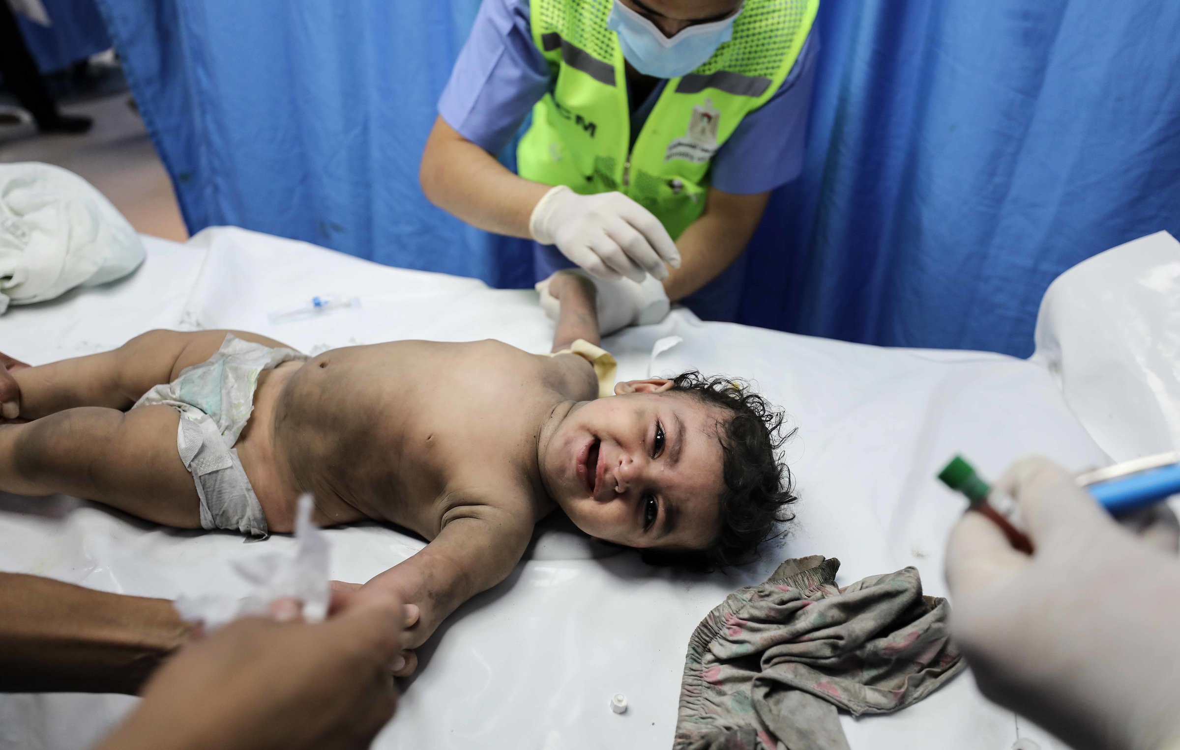 L'immagine mostra un bambino sdraiato su un lettino in un contesto medico. Il bambino, con un'espressione di dolore o disagio, è senza camicia e indossa solo un pannolino. Due adulti, probabilmente medici o infermieri, stanno assistendo il bambino, uno dei quali tiene un bracciale e sembra essere concentrato sulla cura. Lo sfondo è costituito da tende blu, tipico per gli ambienti ospedalieri. L'atmosfera appare seria e si percepisce un clima di urgenza e attenzione.