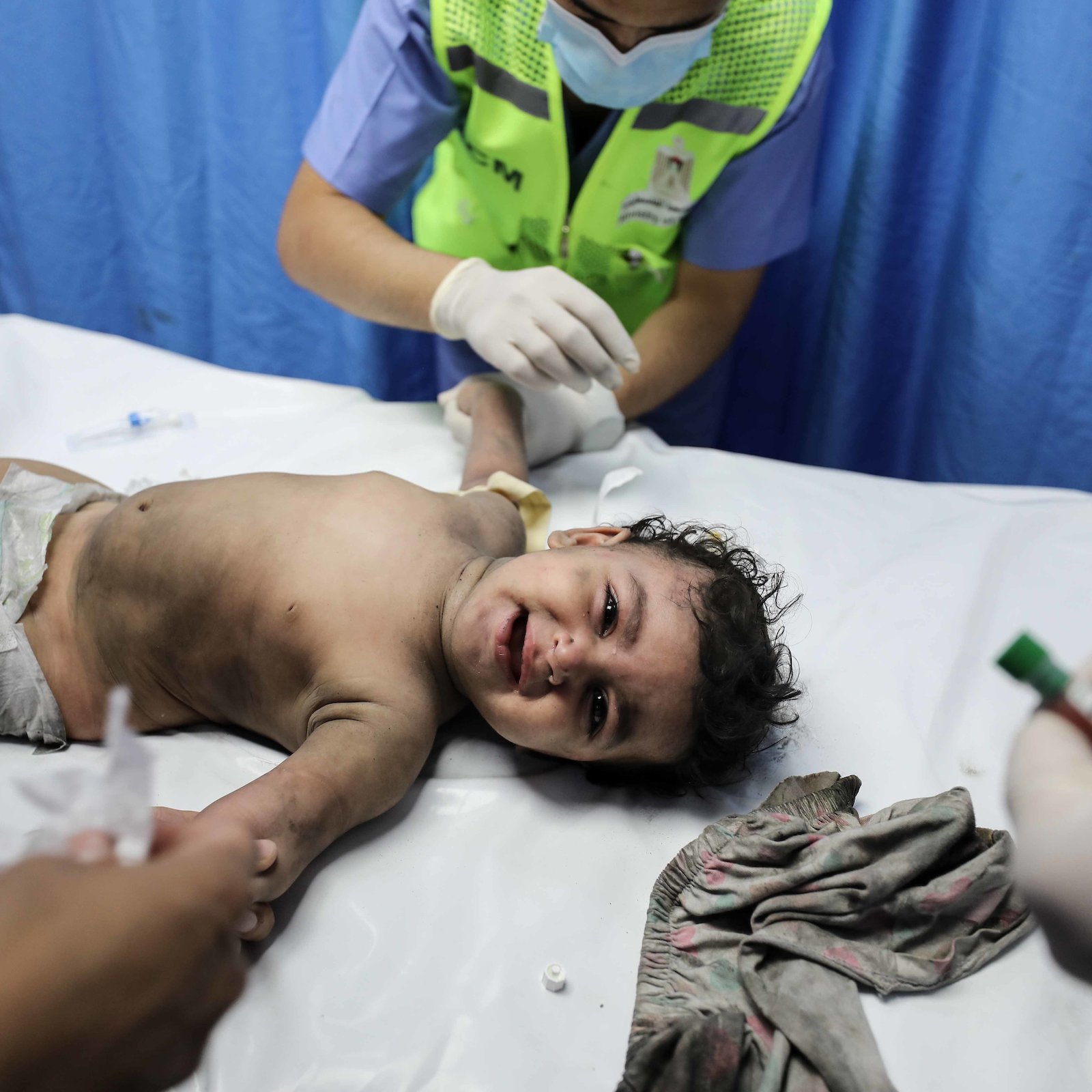 L'image montre un bébé allongé sur une table d'examen médical. L'enfant semble être en cours de traitement, entouré de personnel médical qui lui porte attention. Il est vêtu d'une couche et a un air triste, tout en étant manipulé avec précaution. Le décor est celui d'un hôpital, avec des rideaux bleus en arrière-plan. Des instruments médicaux peuvent être visibles autour de lui.