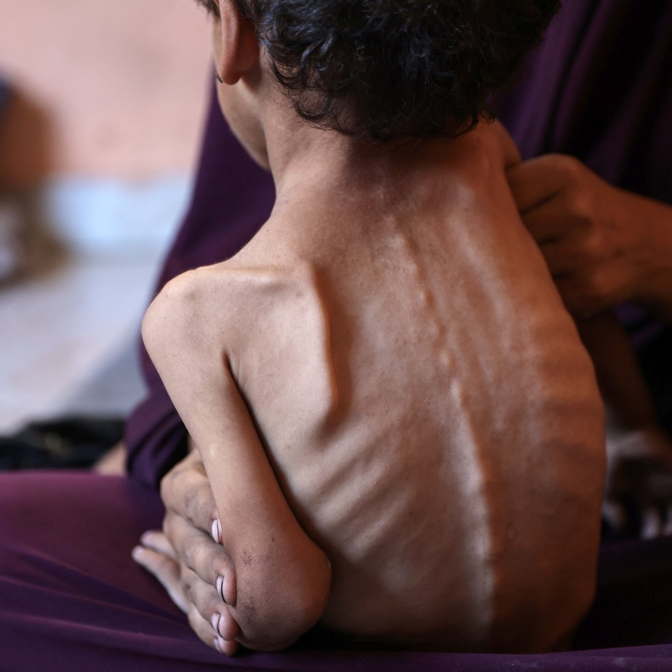 تصویر یک کودک لاغر و آسیب‌پذیر را نشان می‌دهد که در آغوش یک زن نشسته است.