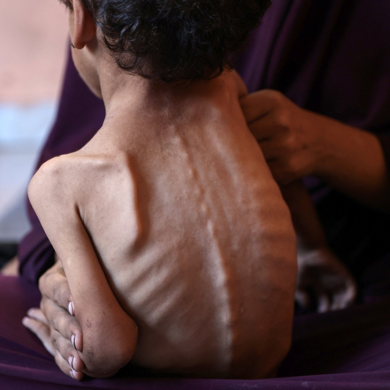 Un enfant très maigre est soutenu par une personne, exprimant une grande détresse.