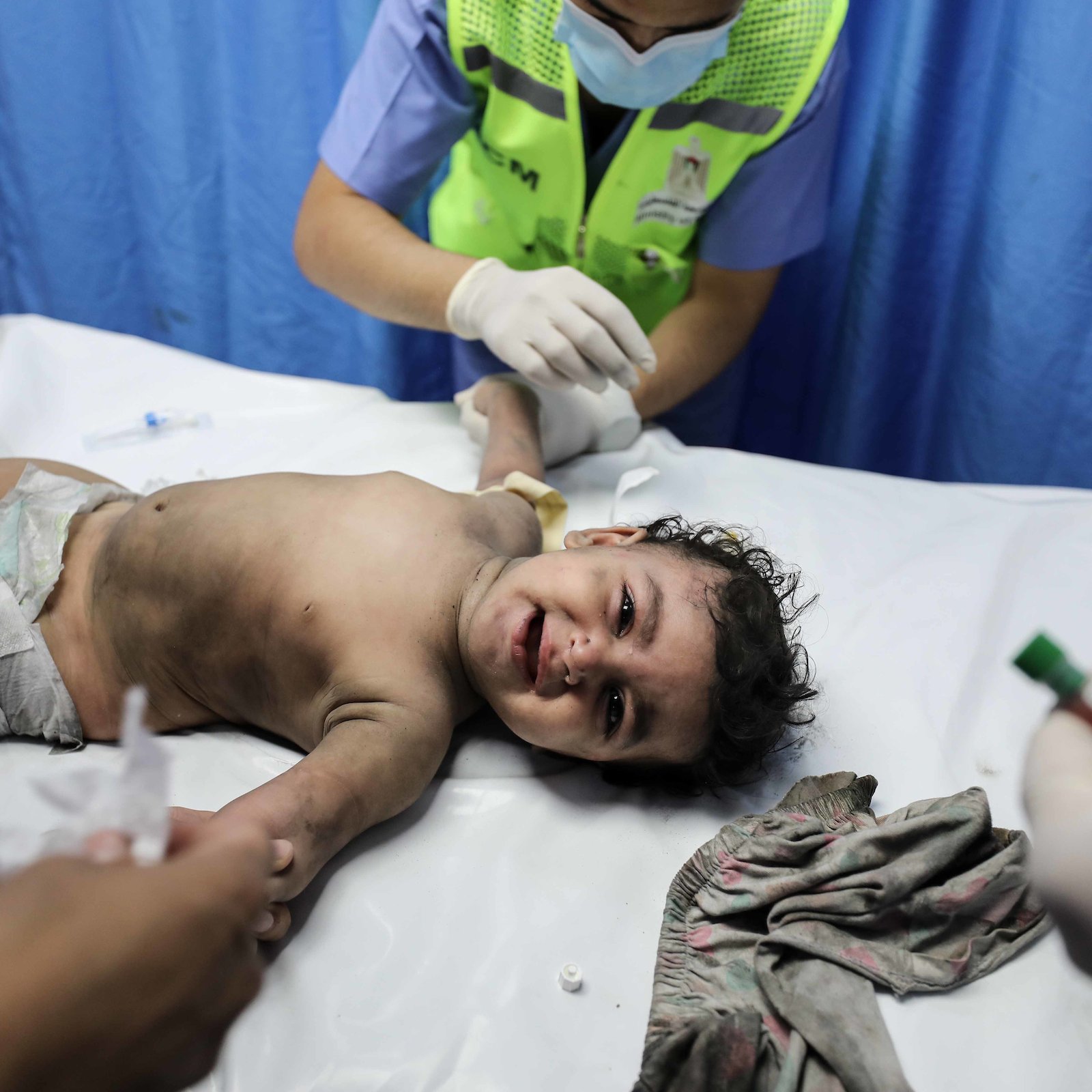 L'immagine mostra un bambino sdraiato su un lettino in un contesto medico. Il bambino, con un'espressione di dolore o disagio, è senza camicia e indossa solo un pannolino. Due adulti, probabilmente medici o infermieri, stanno assistendo il bambino, uno dei quali tiene un bracciale e sembra essere concentrato sulla cura. Lo sfondo è costituito da tende blu, tipico per gli ambienti ospedalieri. L'atmosfera appare seria e si percepisce un clima di urgenza e attenzione.