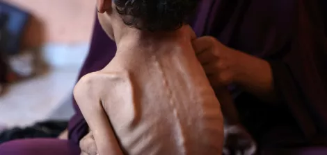 تصویر یک کودک لاغر و آسیب‌پذیر را نشان می‌دهد که در آغوش یک زن نشسته است.