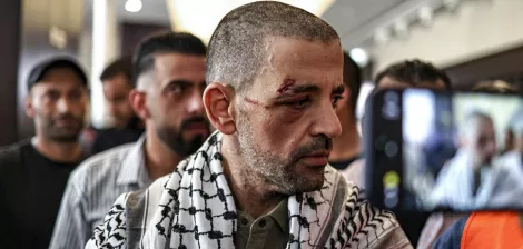 مردی با جراحت روی صورت و شال فلسطینی، در حال صحبت با جمعیتی در پس‌زمینه.