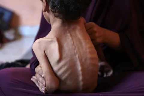 تصویر یک کودک لاغر و آسیب‌پذیر را نشان می‌دهد که در آغوش یک زن نشسته است.